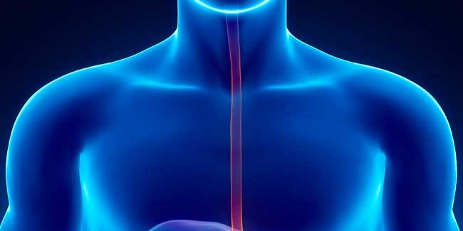 Esófago de Barrett con displasia