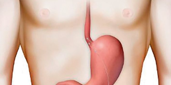 TRATAMIENTO PARA EL REFLUJO: EndoStim