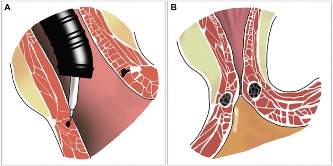 TRATAMIENTO PARA EL REFLUJO: Enteryx