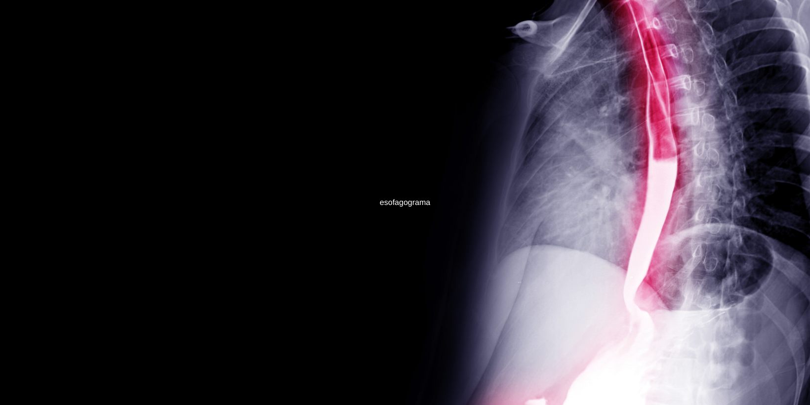 Esofagograma